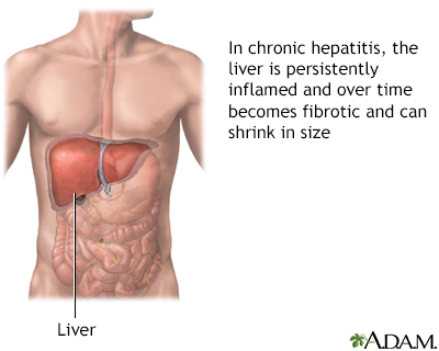 Chronic hepatitis - Illustration Thumbnail
              