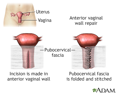 Anterior vaginal wall repair Information