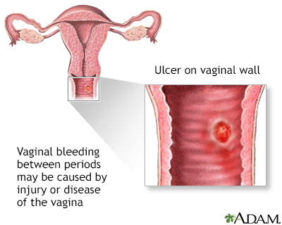 Vaginal bleeding between periods Information