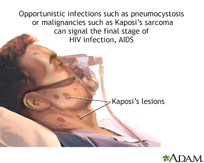 hiv lesions neck