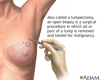 Breast Masses (Breast Lumps) - Gynecology and Obstetrics - Merck