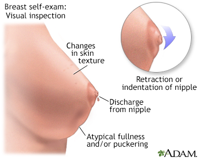Breast self-exam Information
