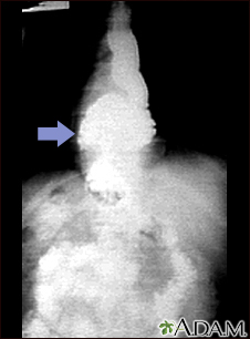Hiatal hernia - X-ray - Illustration Thumbnail              