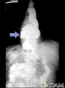 Hiatal hernia - X-ray - Illustration Thumbnail
                      