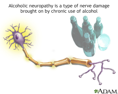 Alcoholic neuropathy - Illustration Thumbnail
              