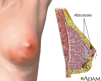 Breast infection - Illustration Thumbnail
              