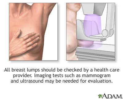 Lump on breast: Types, diagnosis, and other symptoms