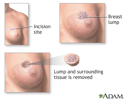 Breast lump removal Information Mount Sinai New York