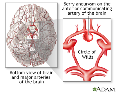 Cerebral aneurysm - Illustration Thumbnail
                      