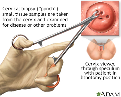 Cervical cancer Information Mount Sinai New York