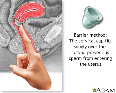 diaphragm vs cervical cap