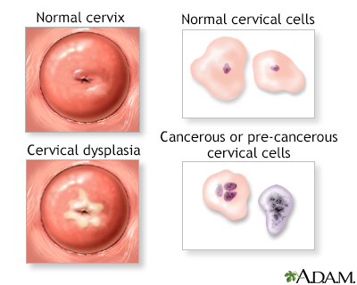 Cervical cancer Information Mount Sinai New York