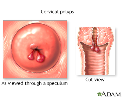 biopsy of polyp on uterus