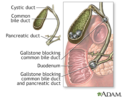 Choledocholithiasis