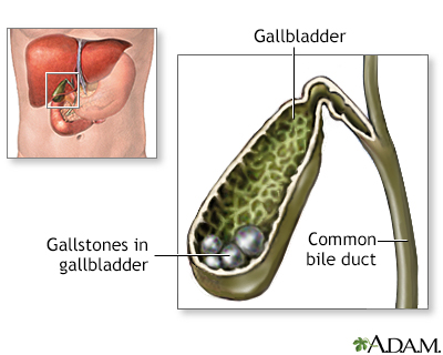 gall bladder stone