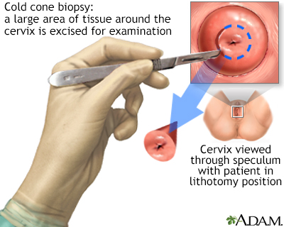 Cold cone biopsy - Illustration Thumbnail
                      