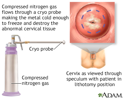 Cervical cryosurgery - Illustration Thumbnail
              