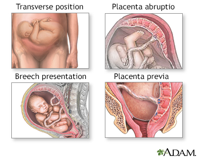 After a C-section - in the hospital Information