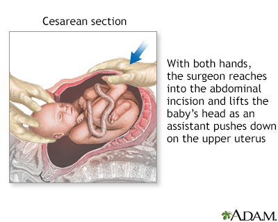 After a C-section - in the hospital Information