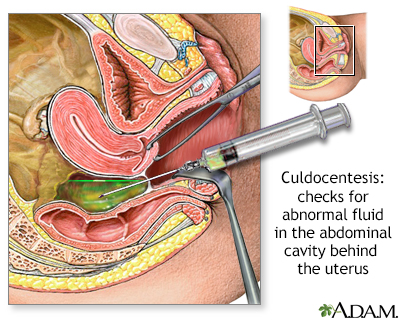 Diagnosis of Ectopic pregnancy - Culdocentesis
