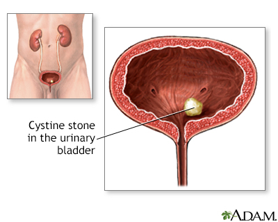 Kidney Stones (Nephrolithiasis) - Symptoms and Causes