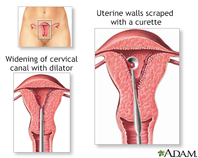 Endometrial cancer Information