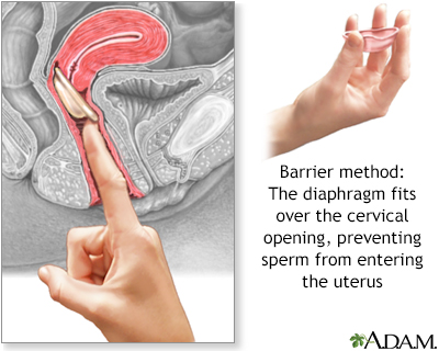 Urethritis in Women  Saint Luke's Health System