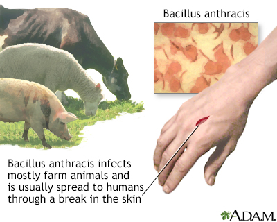 Cutaneous anthrax - Illustration Thumbnail
                      