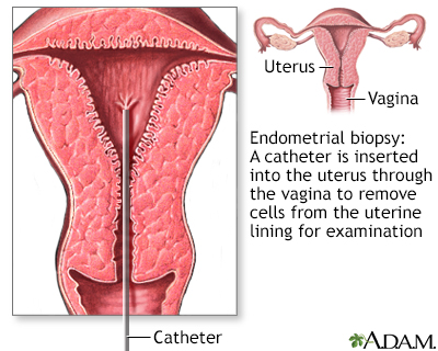 Cancer of endometrial lining. Endometrial cancer no bleeding - pestideacvariu.ro