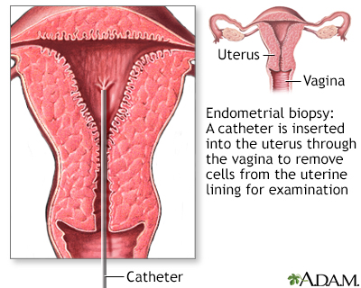 Endometrial biopsy Information