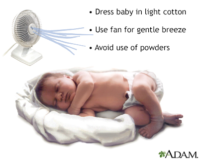 Babies and heat rashes Information