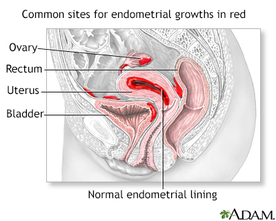 Sharecare on X: Could you spot the signs of endometriosis