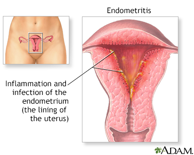 Endometritis - Illustration Thumbnail              