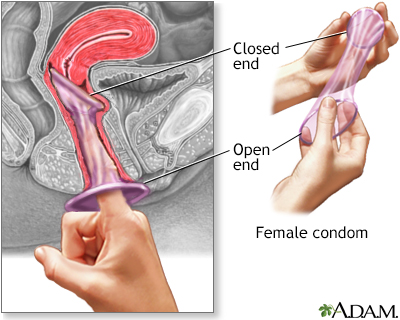 The female condom - Illustration Thumbnail
                      