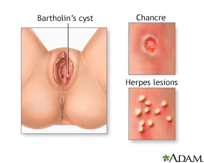 Genital sores (female) - Illustration Thumbnail
              