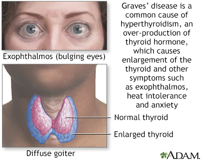 Graves disease Information Mount Sinai New York