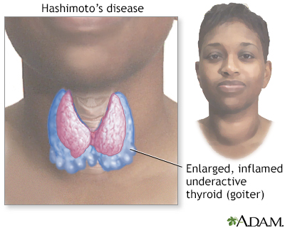 Hashimoto's disease (chronic thyroiditis) - Illustration Thumbnail
                      