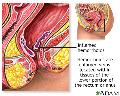 Hemorrhoids - Illustration Thumbnail              