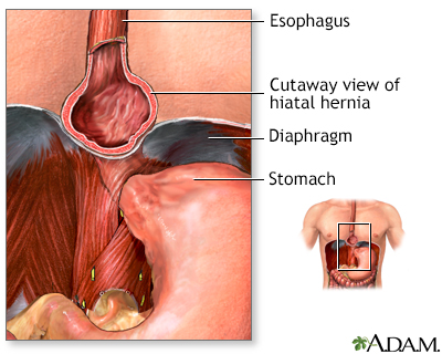 Hiatal hernia - Illustration Thumbnail
                      