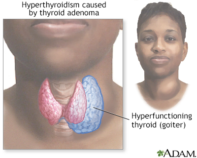 Hyperthyroidism - Illustration Thumbnail              