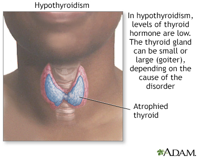 Hypothyroidism - Illustration Thumbnail              