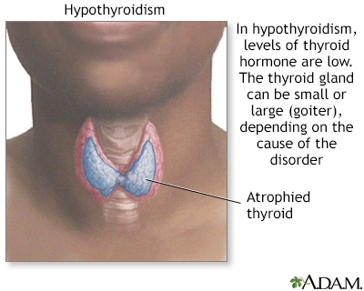 Hypothyroidism Underactive Thyroid Symptoms and Causes