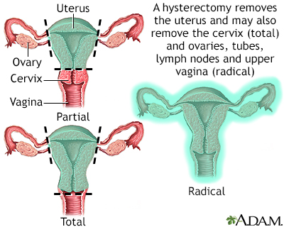 cancer and abdominal hysterectomy)