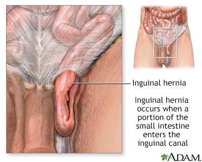 Inguinal hernia - discharge Information