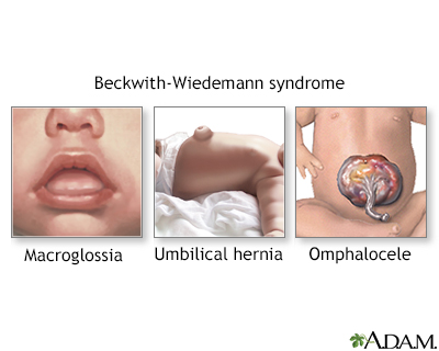 Beckwith-Wiedemann syndrome - Illustration Thumbnail
              