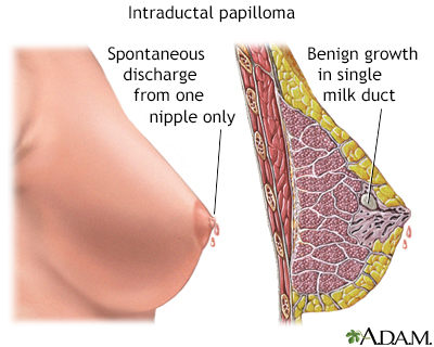 intraductal papillomas symptoms)