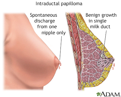 Nipple discharge Information