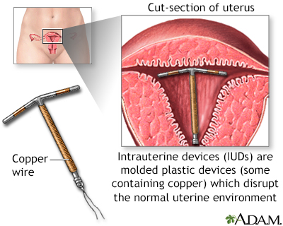 Intrauterine device - Illustration Thumbnail
                      