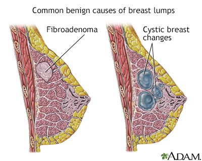 Breast Masses (Breast Lumps) - Gynecology and Obstetrics - Merck