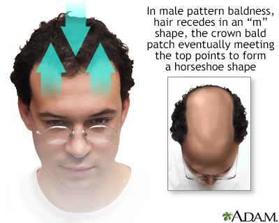 Male pattern baldness - Illustration Thumbnail
                      